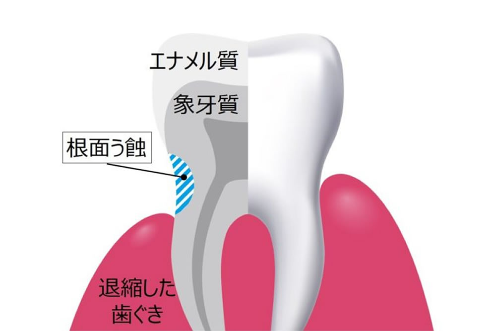 愛知県丹羽郡扶桑町の歯医者・わだち歯科クリニックの、根面う蝕：大人の虫歯治療