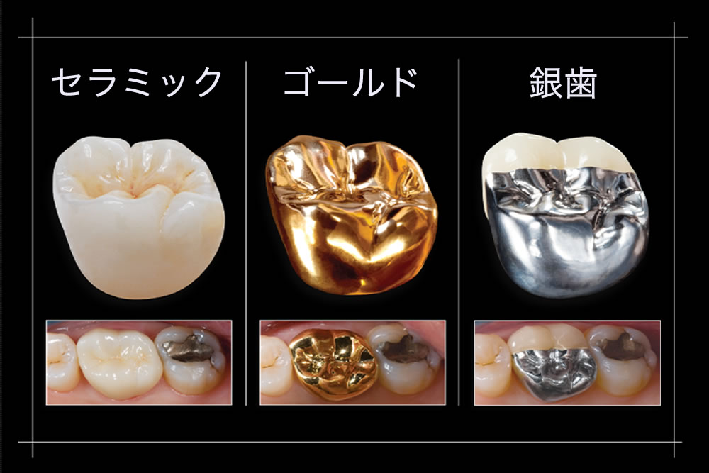 愛知県丹羽郡扶桑町の歯医者・わだち歯科クリニックの、審美歯科治療