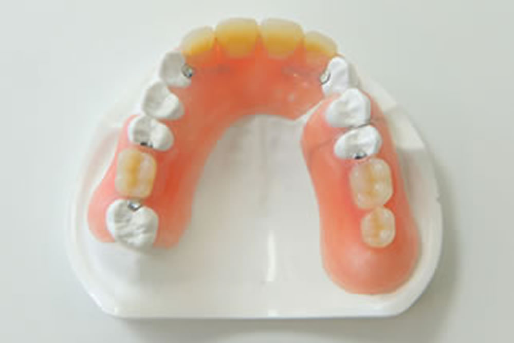 愛知県丹羽郡扶桑町の歯医者・わだち歯科クリニックの、入れ歯治療