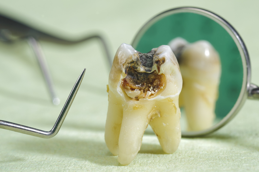 虫歯治療の外観